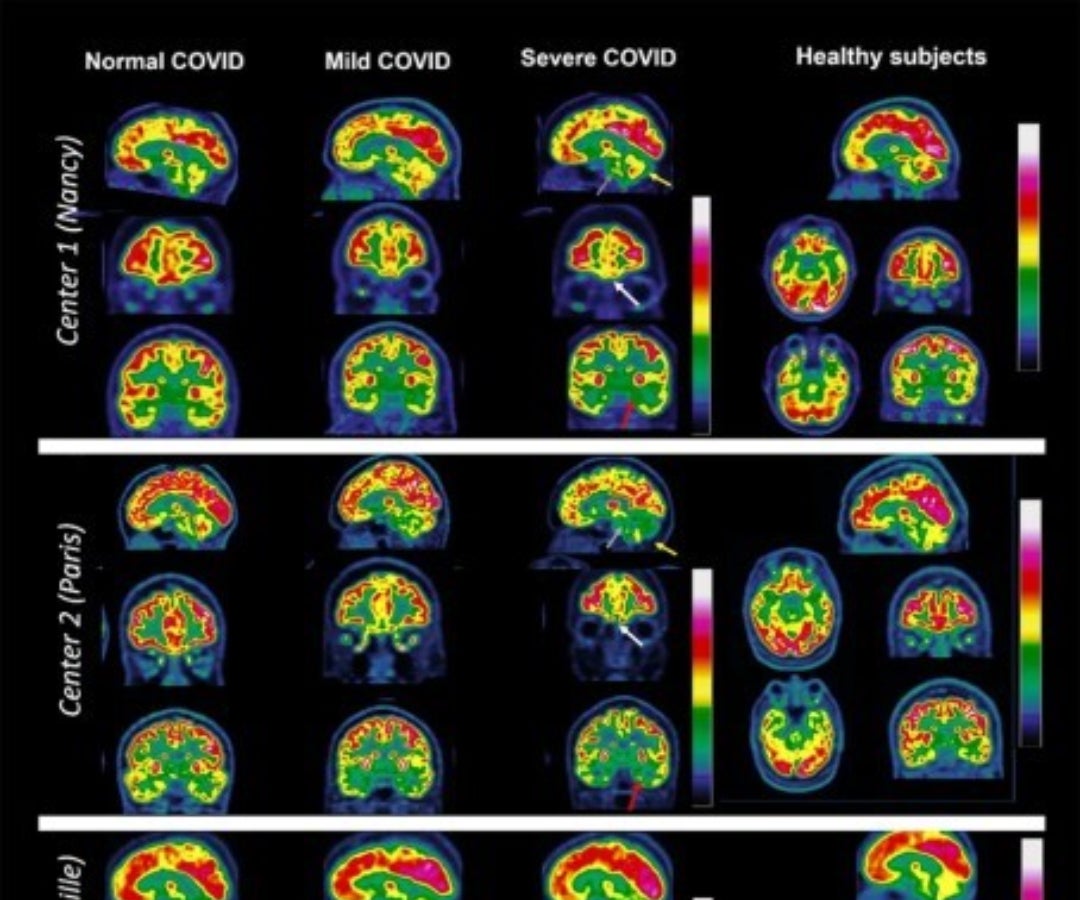 Efectos del covid en el cerebro