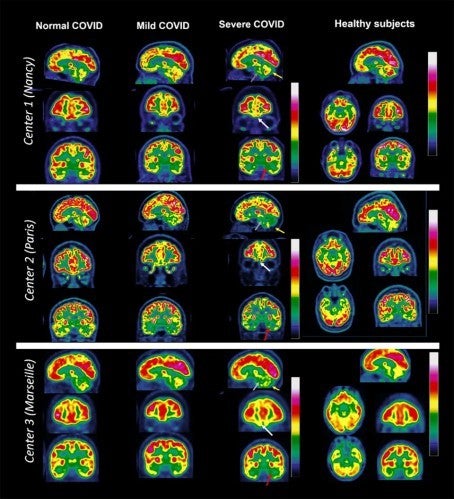 El cerebro con el covid