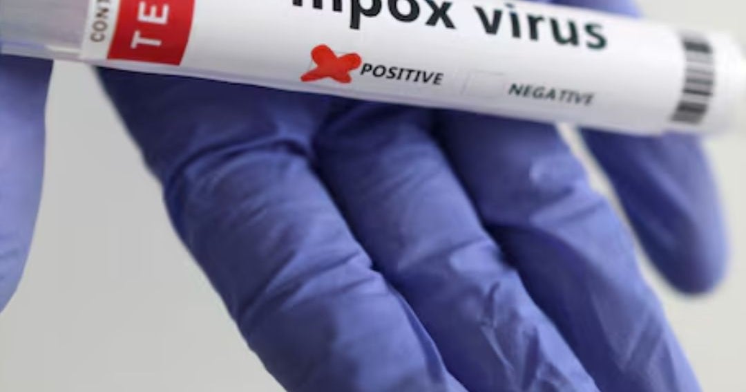 MinSalud confirmó un primer caso de mpox Clado Id, variante de la viruela símica